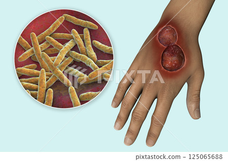 Buruli ulcer on an arm, 3D illustration. The disease caused by Mycobacterium ulcerans bacteria Buruli ulcer on an arm, 3D illustration. The disease caused by Mycobacterium ulcerans bacteria 125065688