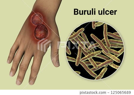 Buruli ulcer on an arm, 3D illustration. The disease caused by Mycobacterium ulcerans bacteria Buruli ulcer on an arm, 3D illustration. The disease caused by Mycobacterium ulcerans bacteria 125065689