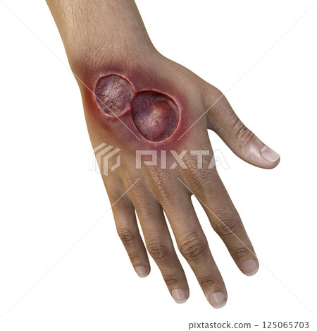 Buruli ulcer on an arm, 3D illustration. The disease caused by Mycobacterium ulcerans bacteria Buruli ulcer on an arm, 3D illustration. The disease caused by Mycobacterium ulcerans bacteria 125065703