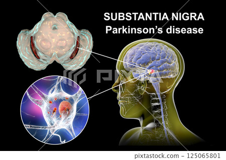 Substantia nigra, a basal banglia of the midbrain, in Parkinson's disease, 3D illustration 125065801
