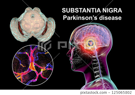 Substantia nigra, a basal banglia of the midbrain, in Parkinson's disease, 3D illustration 125065802
