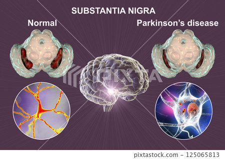 Substantia nigra of the midbrain and its dopaminergic neurons in normal state and in Parkinson's disease, 3D illustration. 125065813