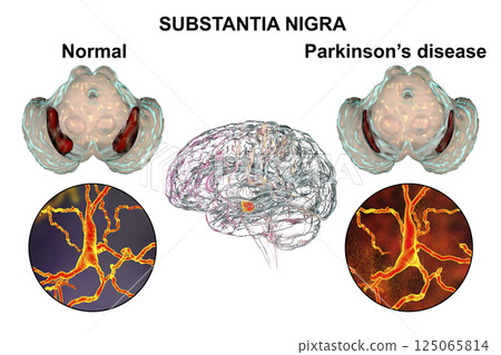 Substantia nigra of the midbrain and its dopaminergic neurons in normal state and in Parkinson's disease, 3D illustration. Substantia nigra of the midbrain and its dopaminergic neurons in normal state and in Parkinson's disease, 3D illustration. 125065814