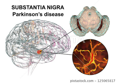 Substantia nigra, a basal banglia of the midbrain, in Parkinson's disease Substantia nigra, a basal banglia of the midbrain, in Parkinson's disease 125065817