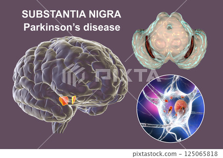 Substantia nigra, a basal banglia of the midbrain, in Parkinson's disease 125065818