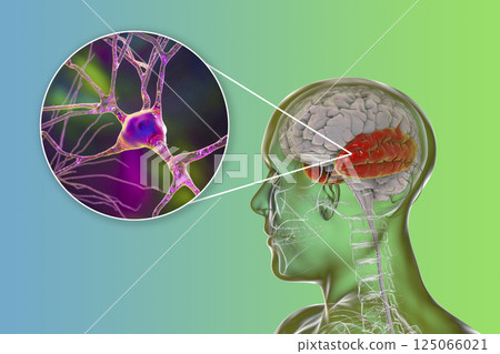Human brain with highlighted temporal lobe and close-up view of neurons Human brain with highlighted temporal lobe and close-up view of neurons 125066021