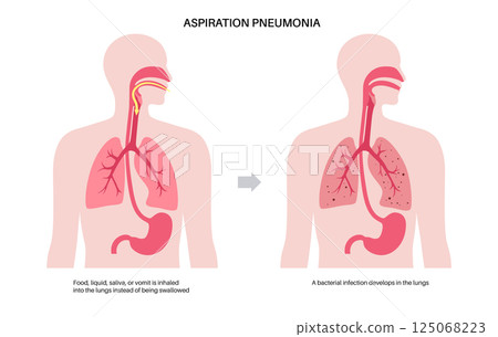 Aspiration pneumonia poster 125068223