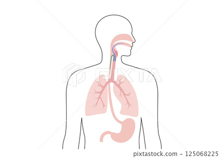 Aspiration pneumonia poster Aspiration pneumonia poster 125068225