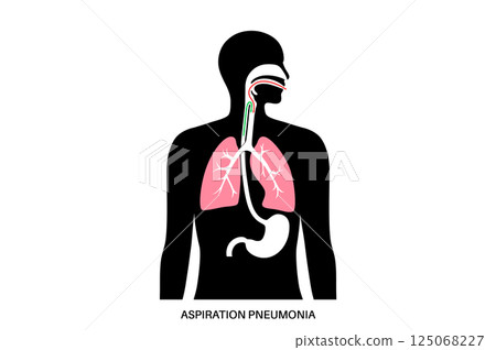 Aspiration pneumonia poster 125068227