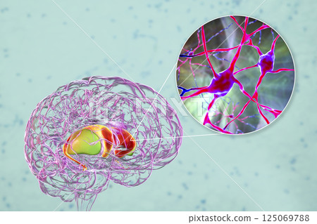 Dorsal striatum in the brain and closeup view of its neurons, 3D illustration Dorsal striatum in the brain and closeup view of its neurons, 3D illustration 125069788