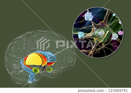 Dorsal striatum and its neurons in the Huntington's disease, 3D illustration Dorsal striatum and its neurons in the Huntington's disease, 3D illustration 125069791