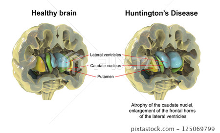 Dorsal striatum and lateral ventricles in healthy brain and in Huntington's disease Dorsal striatum and lateral ventricles in healthy brain and in Huntington's disease 125069799