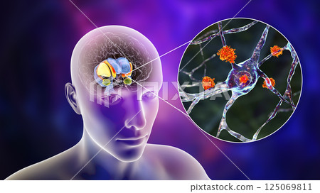 Dorsal striatum and lateral ventricles in the brain of a person with Huntington's disease, 3D illustration Dorsal striatum and lateral ventricles in the brain of a person with Huntington's disease, 3D illustration 125069811