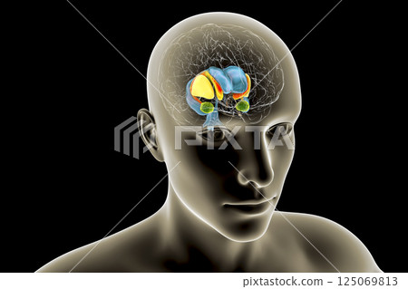 Dorsal striatum and lateral ventricles in the brain of a person with Huntington's disease, 3D illustration Dorsal striatum and lateral ventricles in the brain of a person with Huntington's disease, 3D illustration 125069813