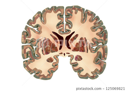 Coronal section of a healthy brain showing normal anatomy of basal baglia Coronal section of a healthy brain showing normal anatomy of basal baglia 125069821