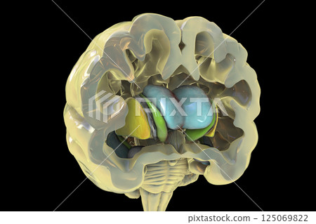 Dorsal striatum and lateral ventricles in Huntington's disease, 3D illustration Dorsal striatum and lateral ventricles in Huntington's disease, 3D illustration 125069822