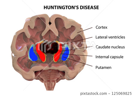 Coronal section of a brain of a person with Huntington's disease 125069825