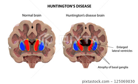 Coronal section of a brain of a person with Huntington's disease 125069830