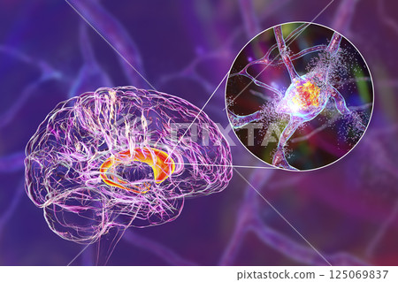 Destruction of neurons of the caudate nucleus, conceptual 3D illustration 125069837