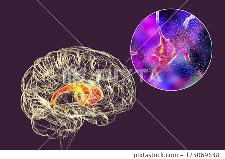 Destruction of neurons of the caudate nucleus, conceptual 3D illustration 125069838
