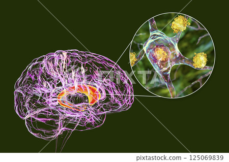 Neuronal inclusions in the caudate nucleus in Huntington's disease Neuronal inclusions in the caudate nucleus in Huntington's disease 125069839