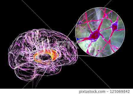 Caudate nuclei highlighted in human brain and closeup view of its neurons Caudate nuclei highlighted in human brain and closeup view of its neurons 125069842