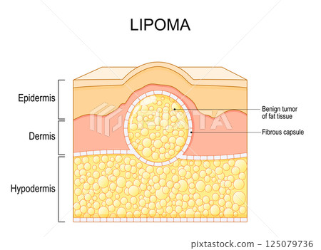 Lipoma. Cross section of a human skin with a fatty lump Lipoma. Cross section of a human skin with a fatty lump 125079736