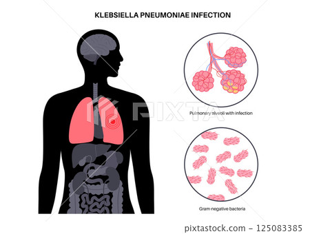 Klebsiella pneumoniae poster 125083385