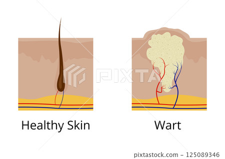 Healthy skin and wart comparison showing arteries and veins Healthy skin and wart comparison showing arteries and veins 125089346