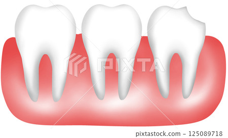 Human tooth anatomy with chipped and broken features 125089718