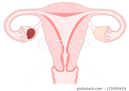 Ovarian cancer stage I (first stage) Easy-to-understand illustration 125098419