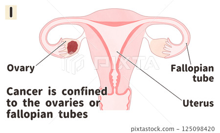 Ovarian cancer stage I (first stage) - Easy-to-understand English illustrations Ovarian cancer stage I (first stage) - Easy-to-understand English illustrations 125098420