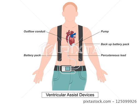 A ventricular assist device (VAD) is a device that helps pump blood. 125099926