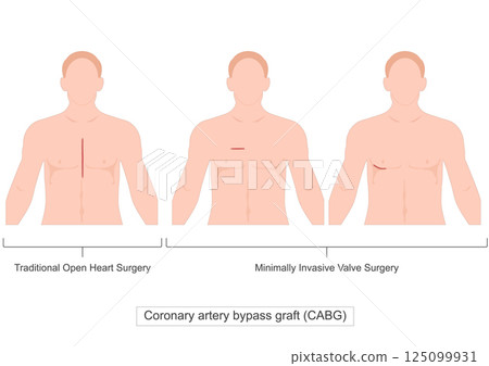 Coronary artery bypass graft (CABG). Coronary artery bypass graft (CABG). 125099931