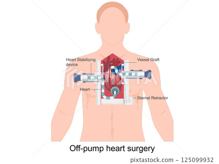 Off-pump heart surgery also called beating heart surgery 125099932