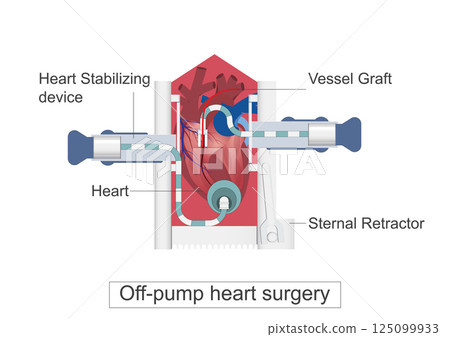 Off-pump heart surgery is a type of coronary artery bypass surgery (CABG) 125099933