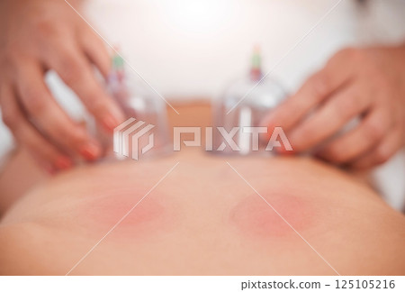 Blood therapy, skincare and cupping for healthcare medical wellness. Peace, luxury physical therapy healing and relax skin physiotherapy with massage therapist hands at spa clinic for calm relaxation 125105216