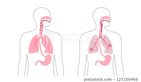 Aspiration pneumonia poster 125108468