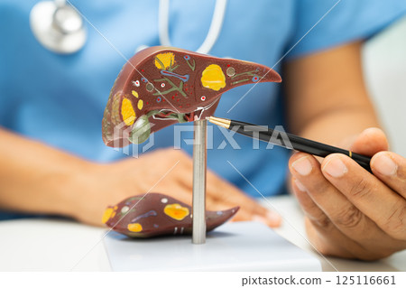 Cirrhosis, Liver cancer, fatty liver, Asian doctor with liver human anatomy model in World Hepatitis Day at hospital. 125116661