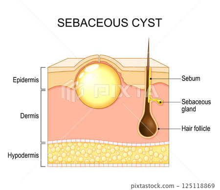 Wen. pilar cyst. Trichilemmal cyst. Sebaceous cyst Wen. pilar cyst. Trichilemmal cyst. Sebaceous cyst 125118869