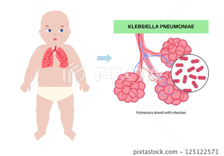 Klebsiella pneumoniae poster Klebsiella pneumoniae poster 125122571
