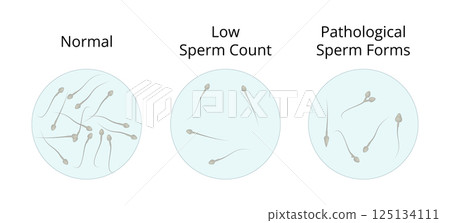 Normal, low and pathological sperm count showing different sperm forms Normal, low and pathological sperm count showing different sperm forms 125134111