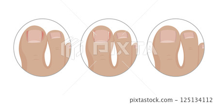 Ingrown toenail surgery using a tamponade, three steps of healing process 125134112