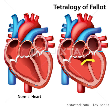 Comparison of Normal Heart and Tetralogy of Fallot 125134383