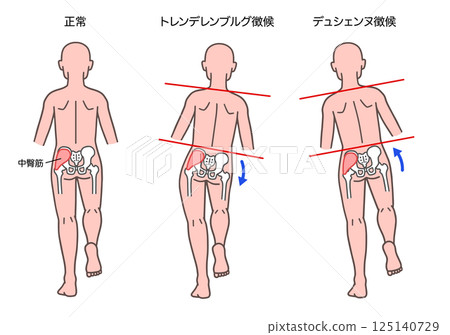 Trendelenburg and Duchenne signs in the human body Trendelenburg and Duchenne signs in the human body 125140729