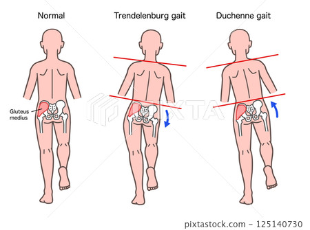 Trendelenburg and Duchenne signs in the human body Trendelenburg and Duchenne signs in the human body 125140730