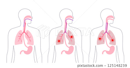 Aspiration pneumonia poster 125148239