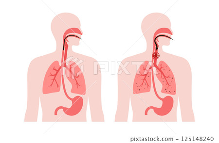 Aspiration pneumonia poster Aspiration pneumonia poster 125148240
