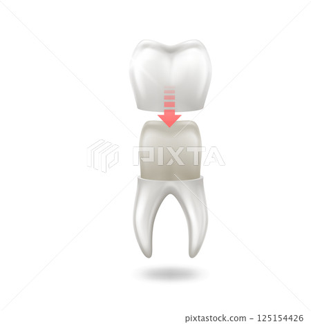 Illustration of Dental Crown Procedure for Tooth Restoration Illustration of Dental Crown Procedure for Tooth Restoration 125154426