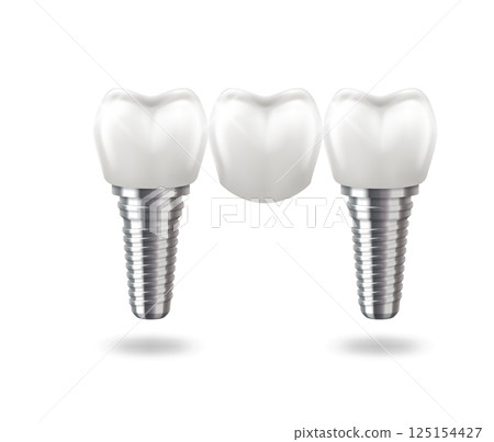 Realistic dental implants on white background 125154427